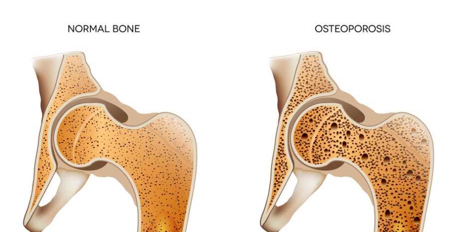 אוסטיאופורוזיס
